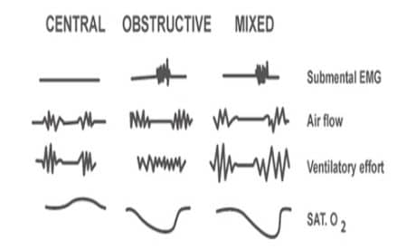 Seep Apnea